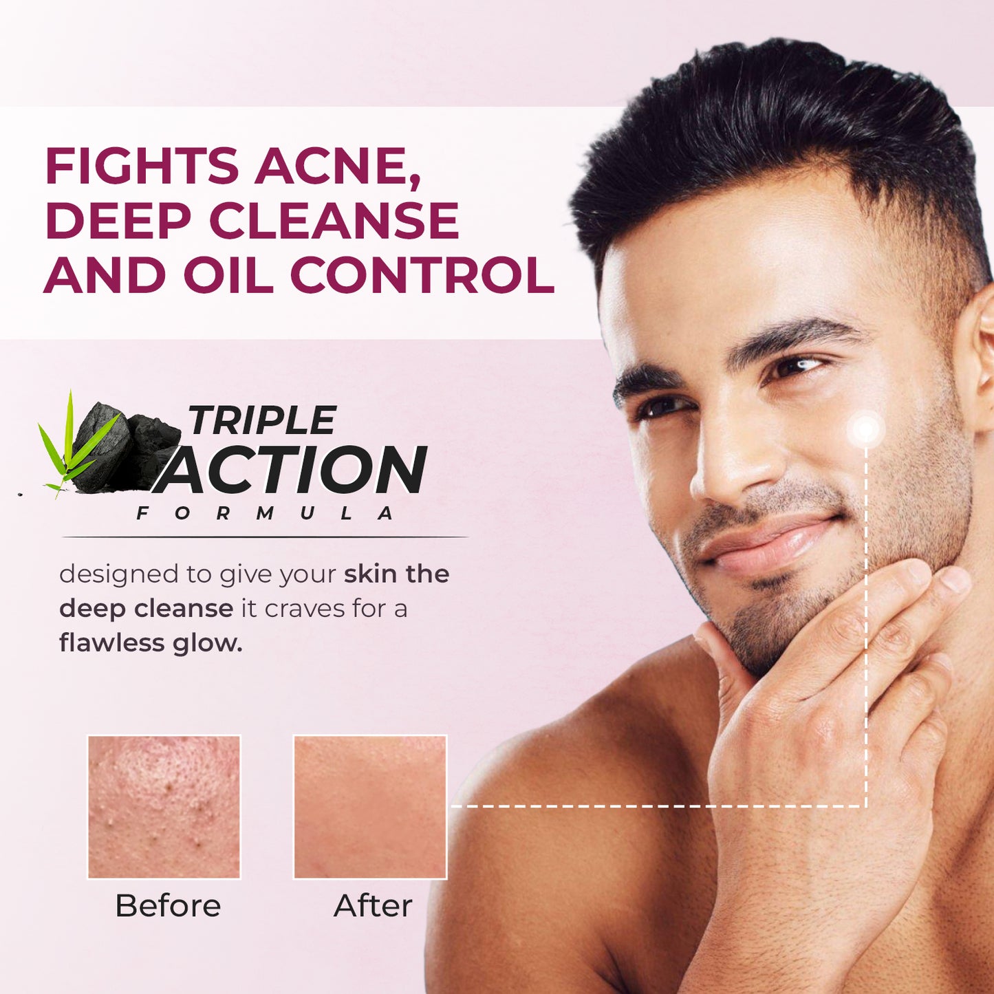 Anti Acne Face Wash 100 Gm