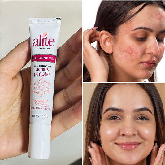 Alite Anti Acne Gel 30 gm